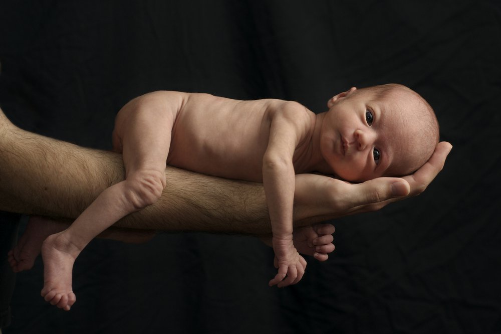 Babies With Low Birth Weight