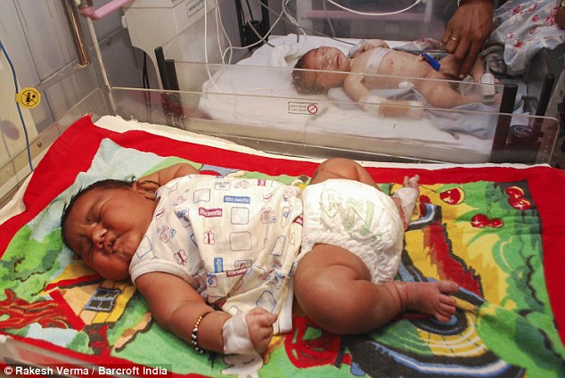 印度最重嬰兒超13磅