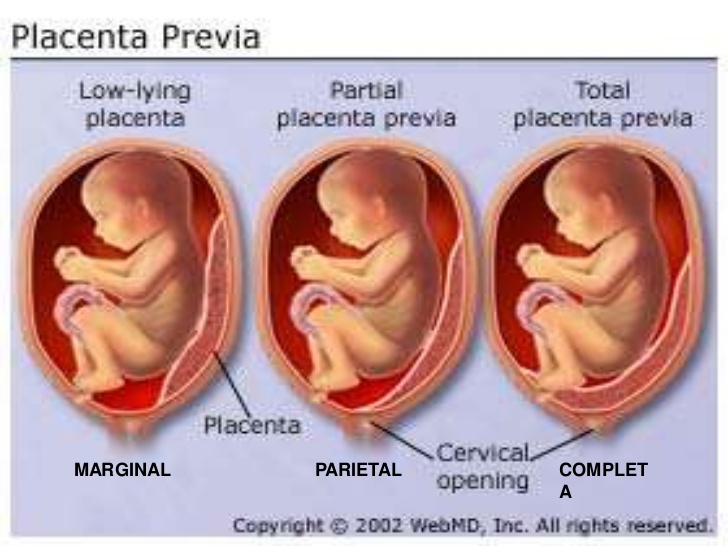 前置胎盤影響懷孕？孕婦健康須知